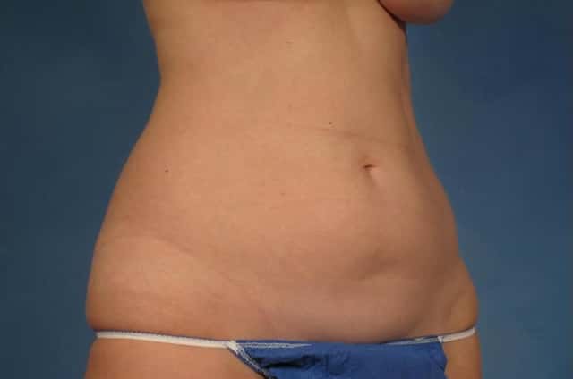 Tummy Tuck (Abdominoplasty) Before and 3 years after, Right Oblique View