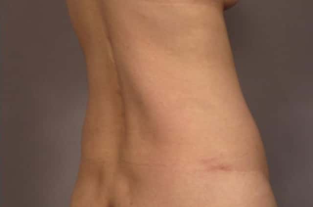Tummy Tuck (Abdominoplasty) Before and 3 years after, Right Posterior Oblique View