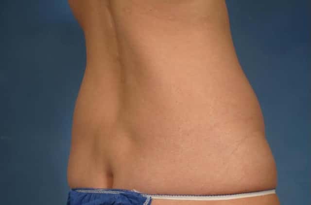 Tummy Tuck (Abdominoplasty) Before and 3 years after, Right Posterior Oblique View