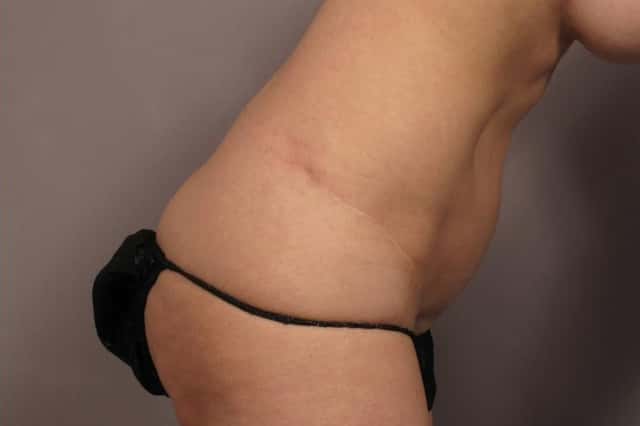 Tummy Tuck (Abdominoplasty) Before and 3 years after, Right Side - Bend Over View