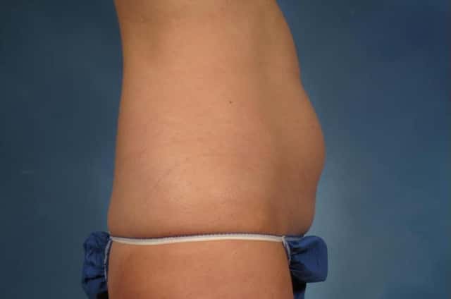 Tummy Tuck (Abdominoplasty) Before and 3 years after, Right Side View