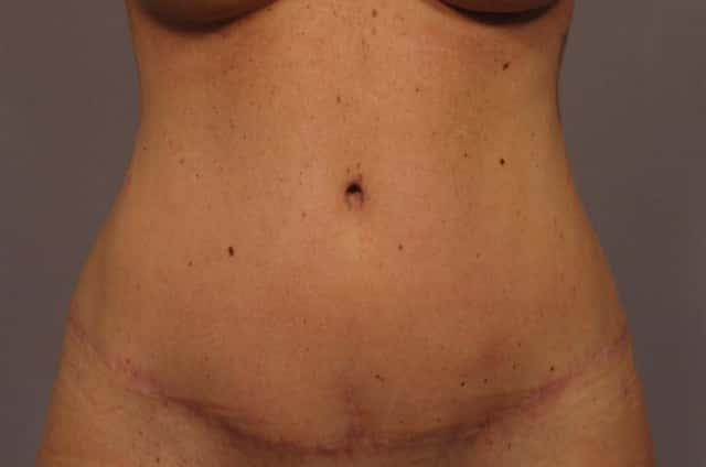 Frontal view, Tummy Tuck with Belly Button Hernia repair, 6 months post-op