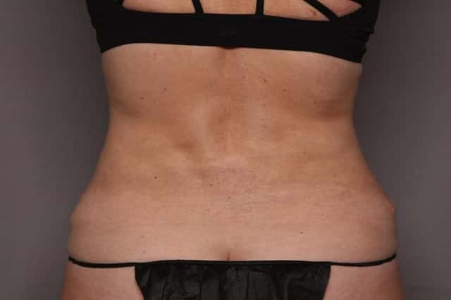 Tummy Tuck by Dr. Kent Hasen, Naples Florida, Back view, 8 months post-op