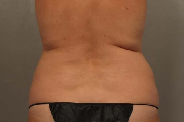Tummy Tuck by Dr. Kent Hasen, Naples Florida, Back view, pre-op