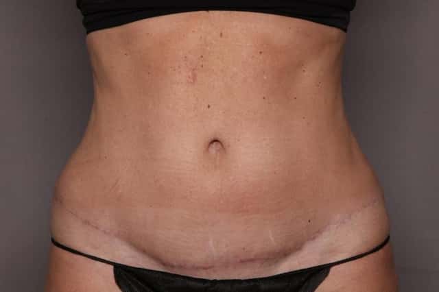 Tummy Tuck by Dr. Kent Hasen, Naples Florida, front view, 8 months Post-op