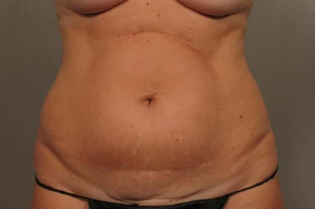 Tummy Tuck by Dr. Kent Hasen, Naples Florida, front view, pre-op