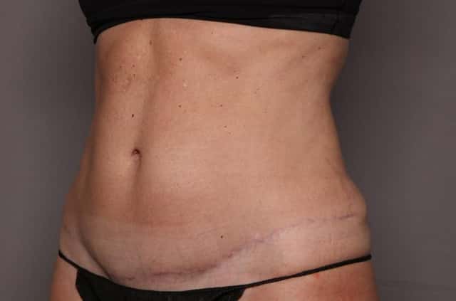 Tummy Tuck by Dr. Kent Hasen, Naples Florida, Left Oblique view, 8 months post-op