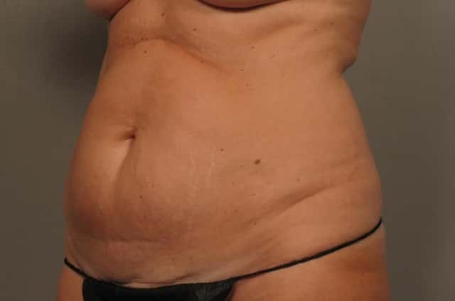 Tummy Tuck by Dr. Kent Hasen, Naples Florida, Left Oblique view, pre-op