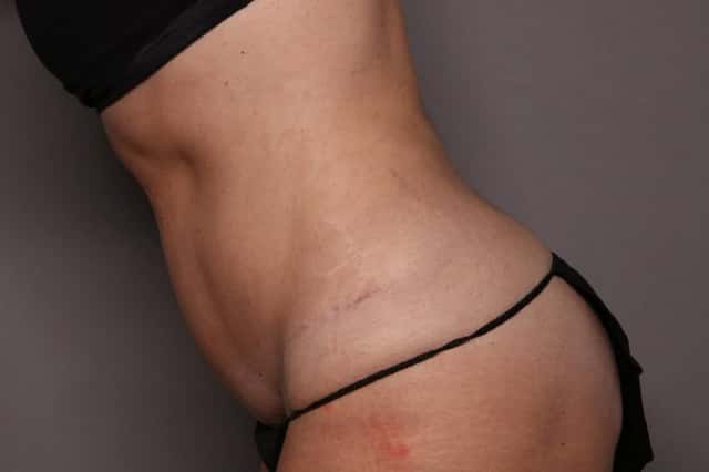 Tummy Tuck by Dr. Kent Hasen, Naples Florida, Left Side view, 8 Months post-op