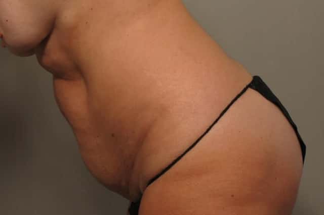 Tummy Tuck by Dr. Kent Hasen, Naples Florida, Left Side view, pre-op
