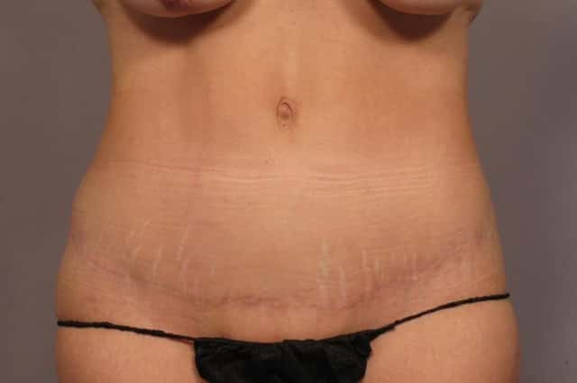 Frontal view before and 9 months after Tummy Tuck and Liposuction in a 50 year old female from Naples, Florida