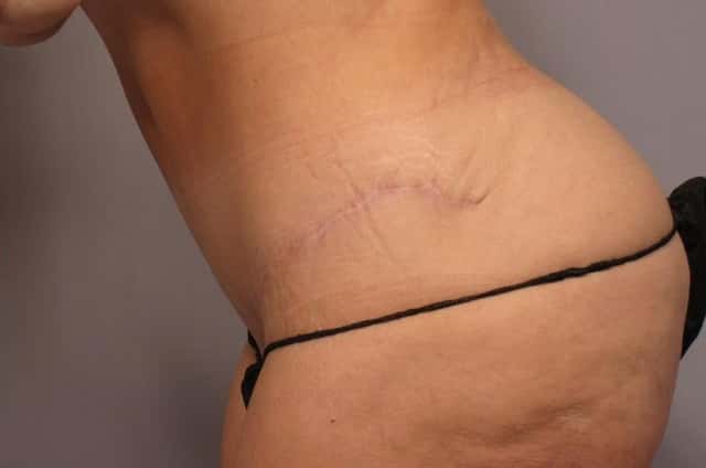 Left Side Down view before and 9 months after Tummy Tuck and Liposuction in a 50 year old female from Naples, Florida