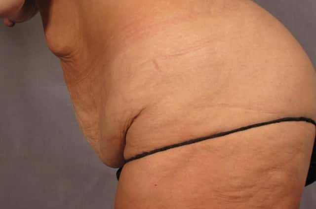 before and 9 months after Tummy Tuck and Liposuction in a 50 year old female from Naples, Florida by Dr. Kent Hasen