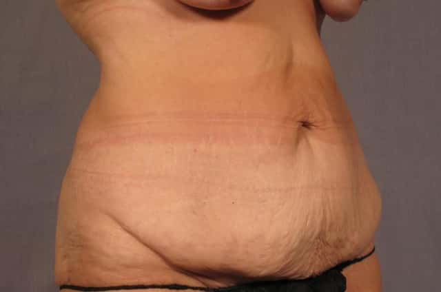 Before and 9 months after Tummy Tuck and Liposuction in a 50 year old female from Naples, Florida Oblique View