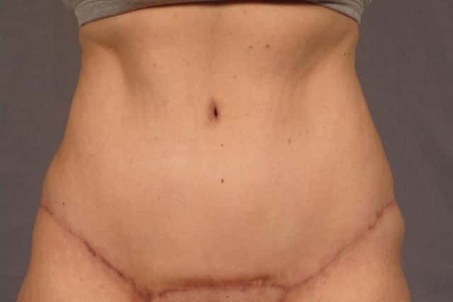 Before and 6 months after photo, frontal view of tummy tuck by Dr. Kent V. Hasen