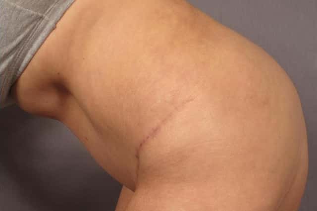 Before and 6 months after photo of tummy tuck by Dr. Kent V. Hasen