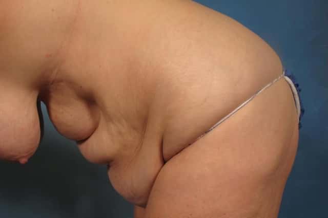 Before and 6 months after photo of tummy tuck, Left Side Down by Dr. Kent V. Hasen