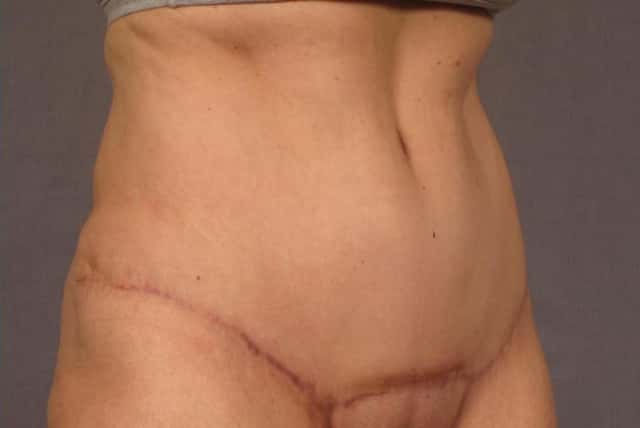 Before and 6 months after photo of tummy tuck by Dr. Kent V. Hasen