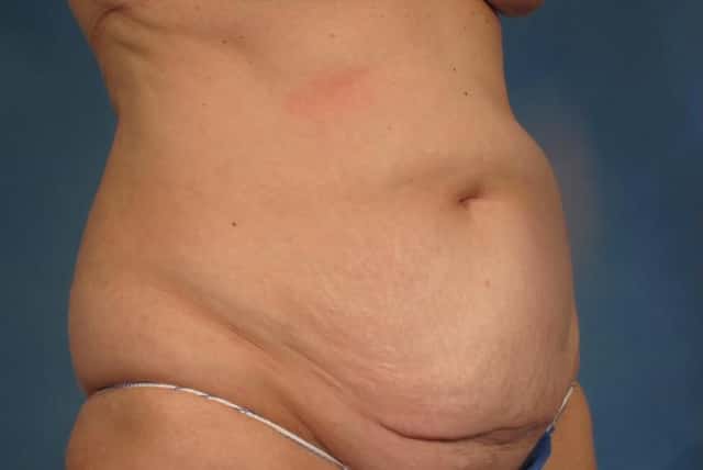 Before and 6 months after photo, Right Oblique view of tummy tuck by Dr. Kent V. Hasen