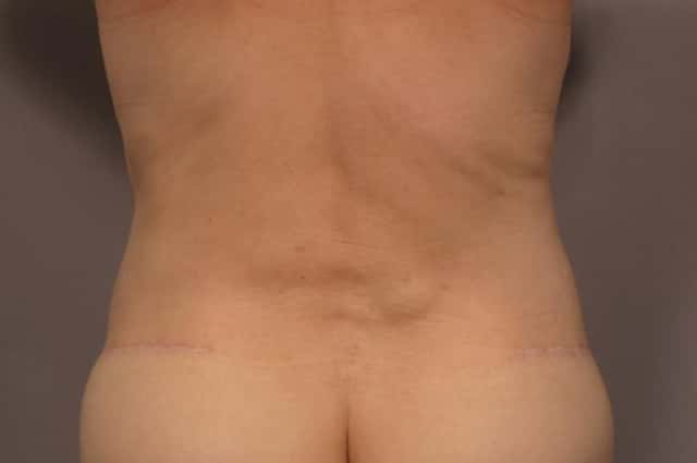 Tummy Tuck with Lipo Before and 1 year after by Dr. Kent Hasen