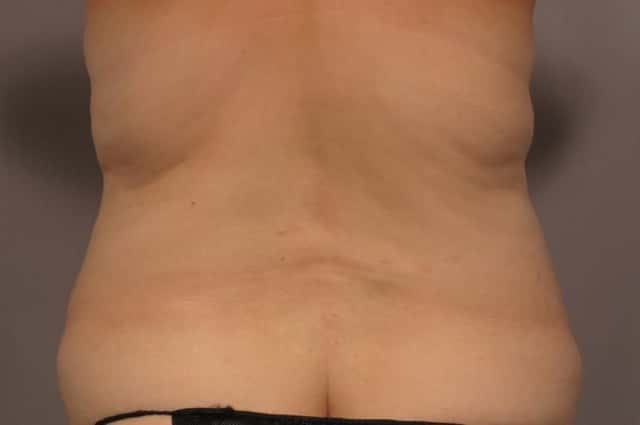 Tummy Tuck with Lipo Before and After Back View by Dr. Kent Hasen in Naples, Florida