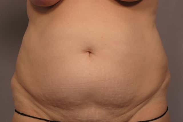 Tummy Tuck before and after photo,frontal view by Kent V. Hasen, MD in Naples, Florida