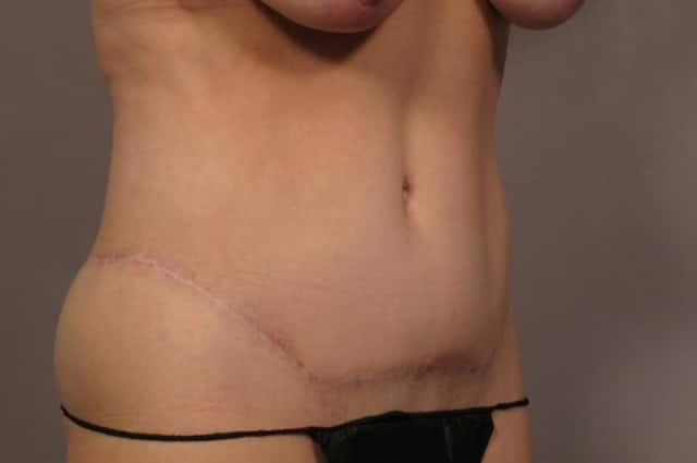 Before and 1 year After Photo of Tummy tuck by Dr. Kent Hasen in Naples, Florida