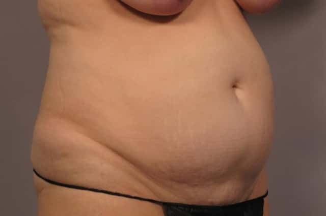 Before and 1 year After Photo of Tummy tuck Right Oblique view by Dr. Kent Hasen in Naples, Florida