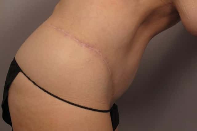 Tummy Tuck Before and 1 Year After by Dr. Kent Hasen in Naples, Florida