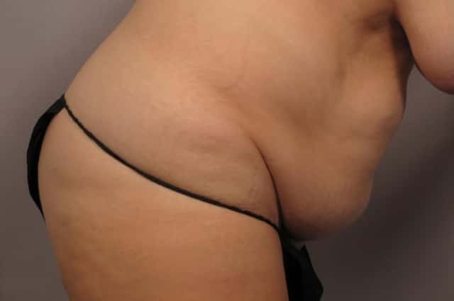 Tummy Tuck Before and After Right Side Down view by Dr. Kent Hasen in Naples, Florida