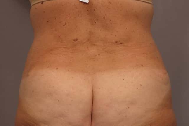 Before and After photo at 1 year after Tummy Tuck and Liposuction by Kent V. Hasen, MD