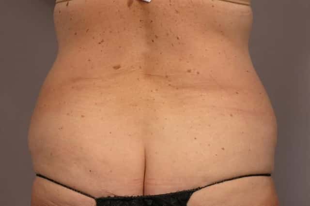 Before and After photo, Posterior View at 1 year after Tummy Tuck and Liposuction by Kent V. Hasen, MD