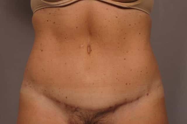 Before and After photo at 1 year after Tummy Tuck by Kent V. Hasen, MD