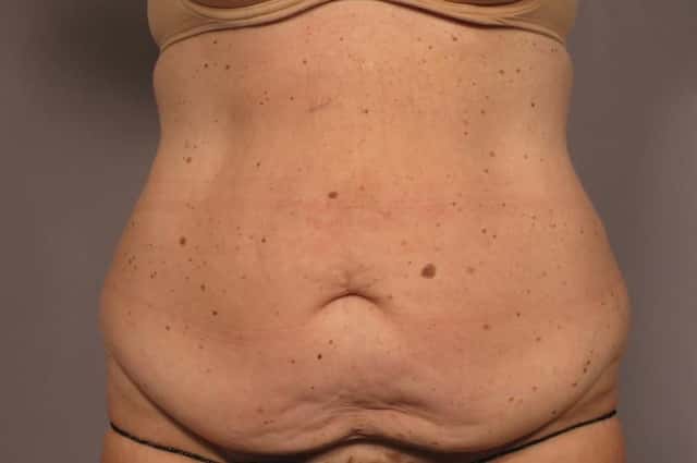 Tummy tuck, before and after 1 year, frontal view, Dr Kent Hasen