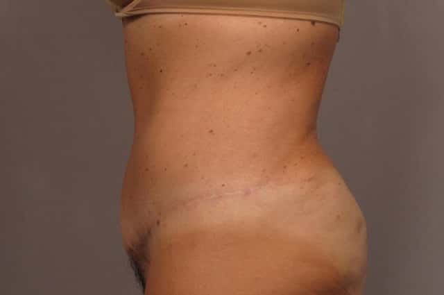 Before and After photo at 1 year after Tummy Tuck by Kent V. Hasen, MD