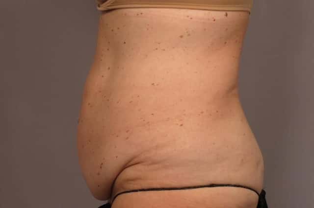 Before and After photo Left Side at 1 year after Tummy Tuck by Kent V. Hasen, MD