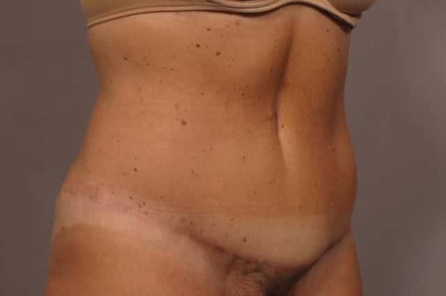 Before and After photo at 1 year after Tummy Tuck by Kent V. Hasen, MD