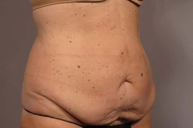 Before and After photo Right Oblique at 1 year after Tummy Tuck by Kent V. Hasen, MD