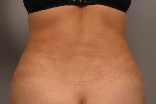 Before and 3 Months After Tummy Tuck and Liposuction by Dr. Kent V. Hasen