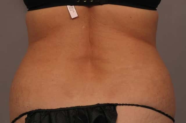 Tummy Tuck and Liposuction, Before and 3 Months After, Back View Photos by Dr. Kent V. Hasen