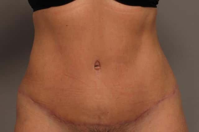 Before and 3 Months After Tummy Tuck by Dr. Kent V. Hasen