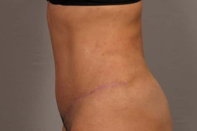 Before and 3 Months After Tummy Tuck by Dr. Kent V. Hasen