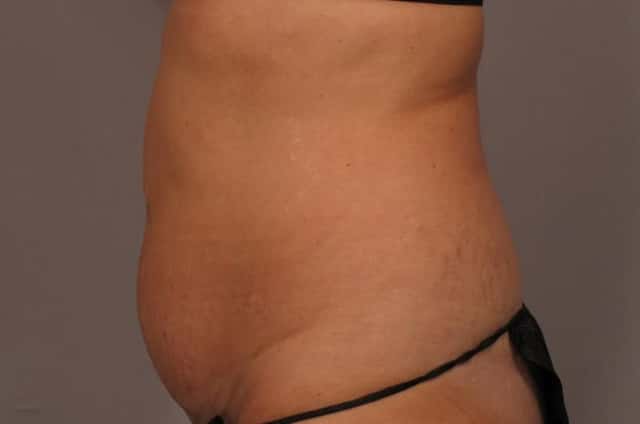 Tummy Tuck, Before and 3 Months After, Left Side View Photos by Dr. Kent V. Hasen