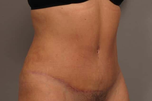 Before and 3 Months After Tummy Tuck by Dr. Kent V. Hasen