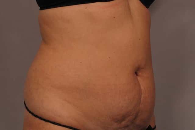 Tummy Tuck, Before and 3 Months After, Right Oblique View Photos by Dr. Kent V. Hasen