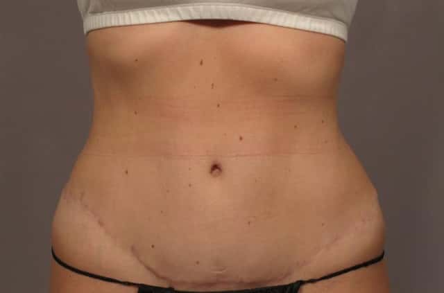 Before and After 1 year from Tummy Tuck by Dr. Kent Hasen