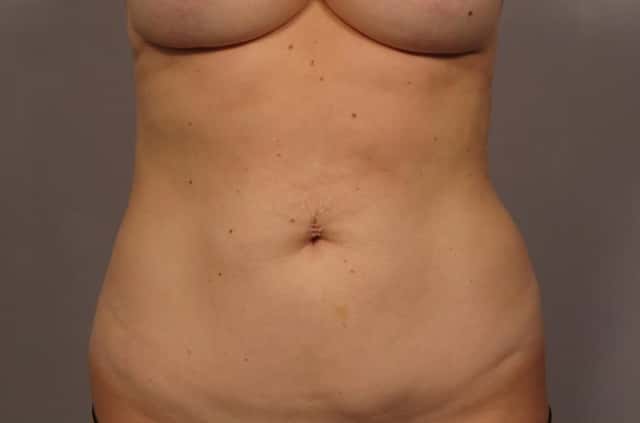 Tummy Tuck, Frontal View, Before and After 1 year photos, Dr. Kent Hasen