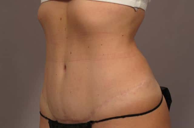 Before and After 1 year Tummy Tuck by Dr. Kent Hasen
