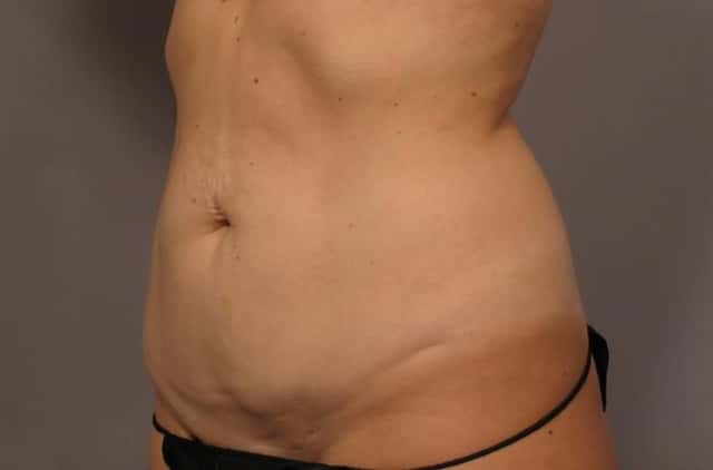 Tummy Tuck, Left Oblique View, Before and After 1 year Photos, Dr. Kent Hase