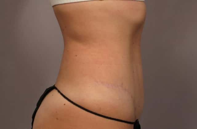 Before and After 1 year Tummy Tuck by Dr. Kent Hasen